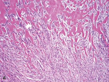 Figure 41.17, Myositis Ossificans.