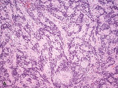 Figure 41.18, Intranodal Palisaded Myofibroblastoma.