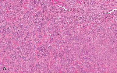 Figure 41.19, Mammary-Type Myofibroblastoma.