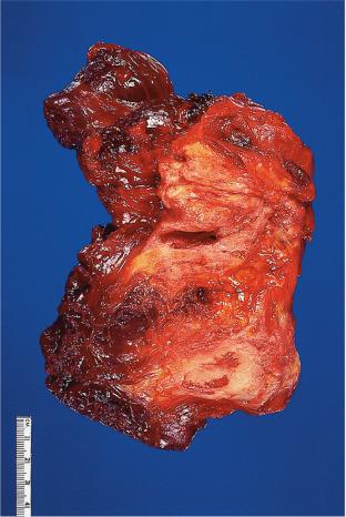 Figure 41.20, Gross appearance of elastofibroma.