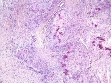 Figure 41.2, Low-power appearance of calcifying aponeurotic fibroma.