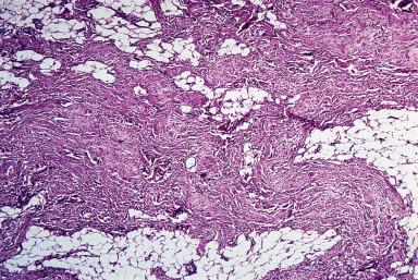 Figure 41.21, Low-power view of elastofibroma with an irregularly shaped fibrohyaline mass within adipose tissue.