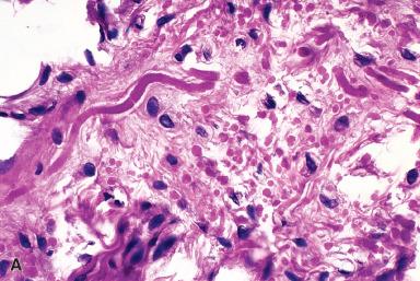 Figure 41.22, High-power view of elastofibroma showing (A) diagnostic rods of elastic tissue ( B, elastic tissue stain).