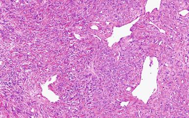 Figure 41.23, Solitary fibrous tumor showing a prominent hemangiopericytoma-like vascular pattern and variable cellularity.