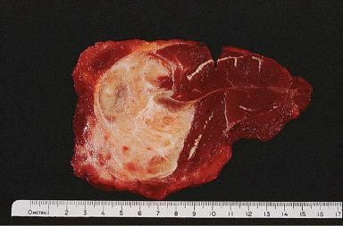 Figure 41.25, Deep-seated fibromatosis embedded within major skeletal muscle.