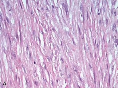 Figure 41.28, Inclusion Body Fibromatosis.