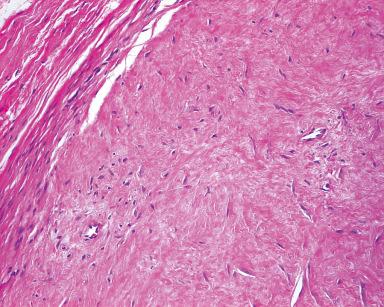 Figure 41.4, Fibroma of Tendon Sheath.