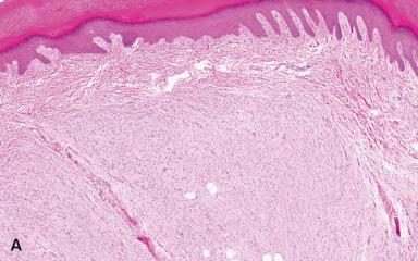 Figure 41.6, Superficial Acral Fibromyxoma.