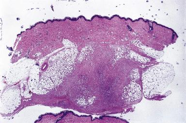 Figure 41.8, Panoramic View of Nodular Fasciitis.