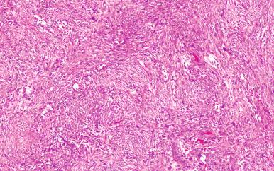 Figure 41.9, Strikingly cellular zone in nodular fasciitis.