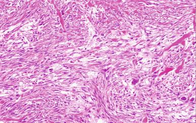 Figure 41.10, Nodular fasciitis with prominent collagen deposition and scattered giant cells.