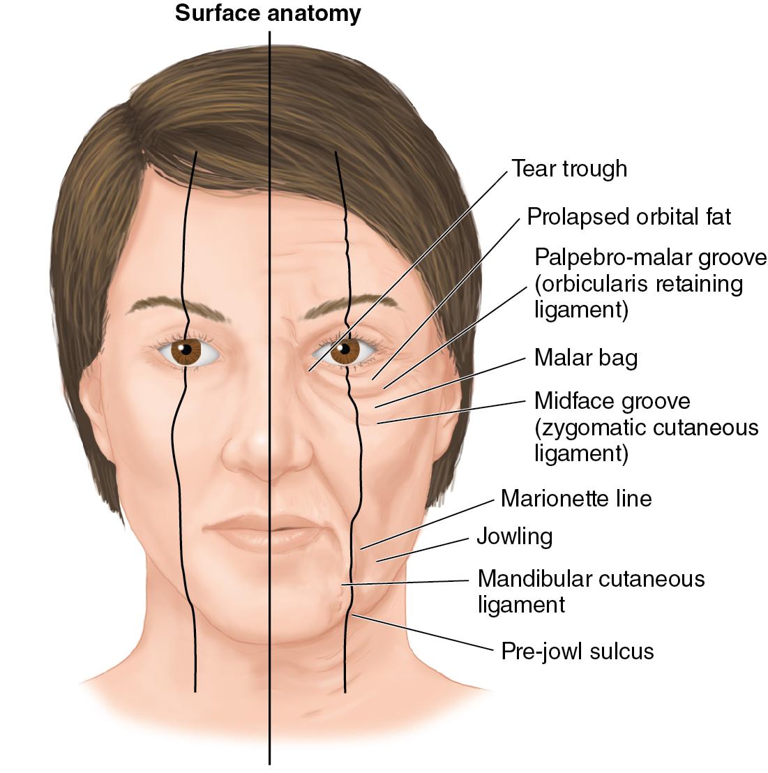 Fig. 34.2, This figure shows predictable anatomic surface changes that occur during facial aging. Note the deflation and descent affecting predictable areas as it relates to the retaining ligaments of the face.