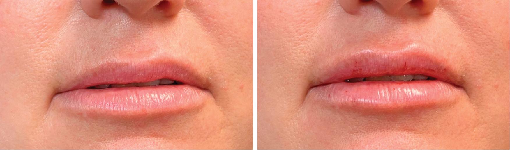 Fig. 4.1, Before and after one syringe of hyaluronic acid filler.