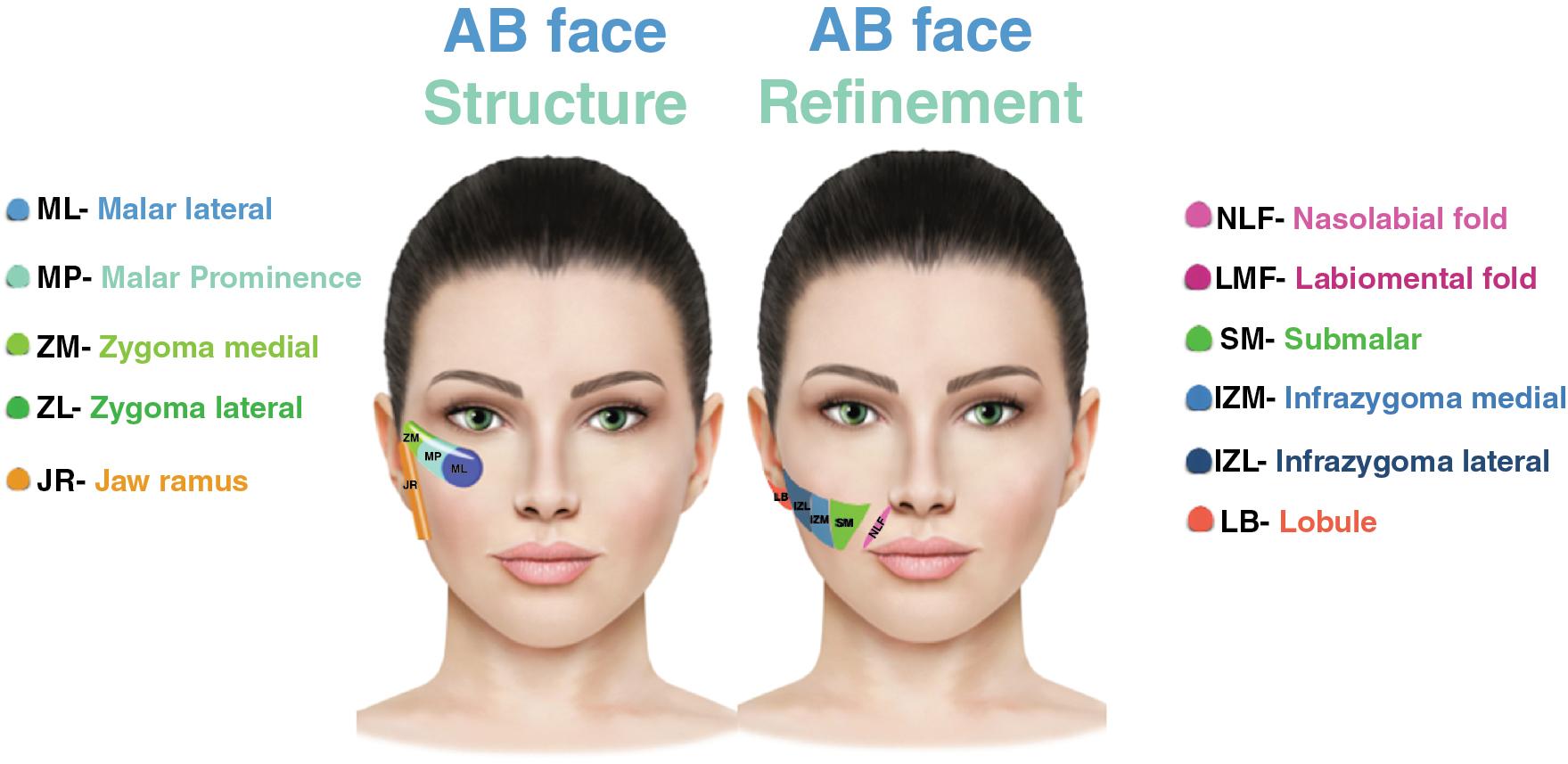 Fig. 4.2, Midface anatomical facial areas that can be treated with fillers.