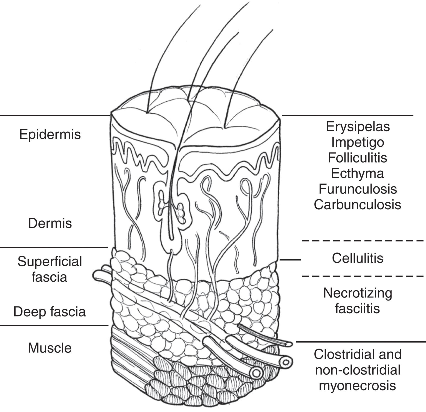 FIGURE 1, Skin structures with corresponding infection.