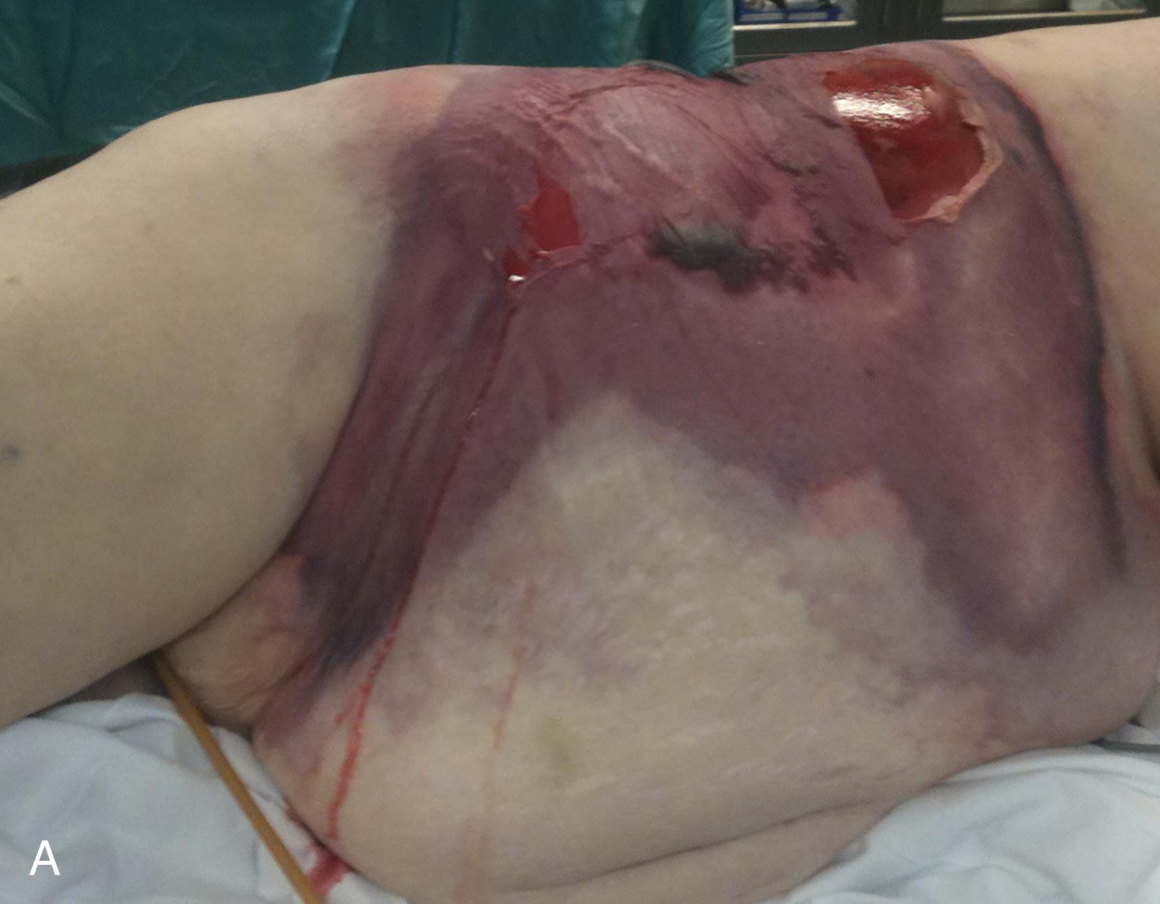 FIGURE 4, (A) Skin changes with characteristic violaceous discoloration associated with skin necrosis resulting from vascular thrombosis. (B) Operative debridement of necrotizing soft tissue infection involving the buttock with extensive necrosis of the superficial and deep fascia foul odor.