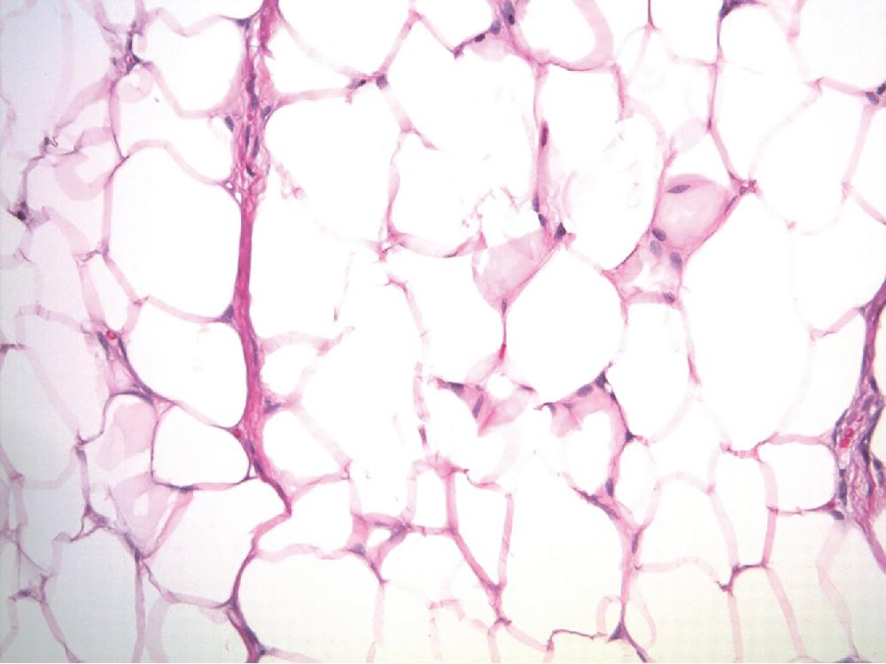 Fig. 8.1, Lipoma is composed of mature adipocytes, with little to no variation in size and shape and often thin fibrous septa.