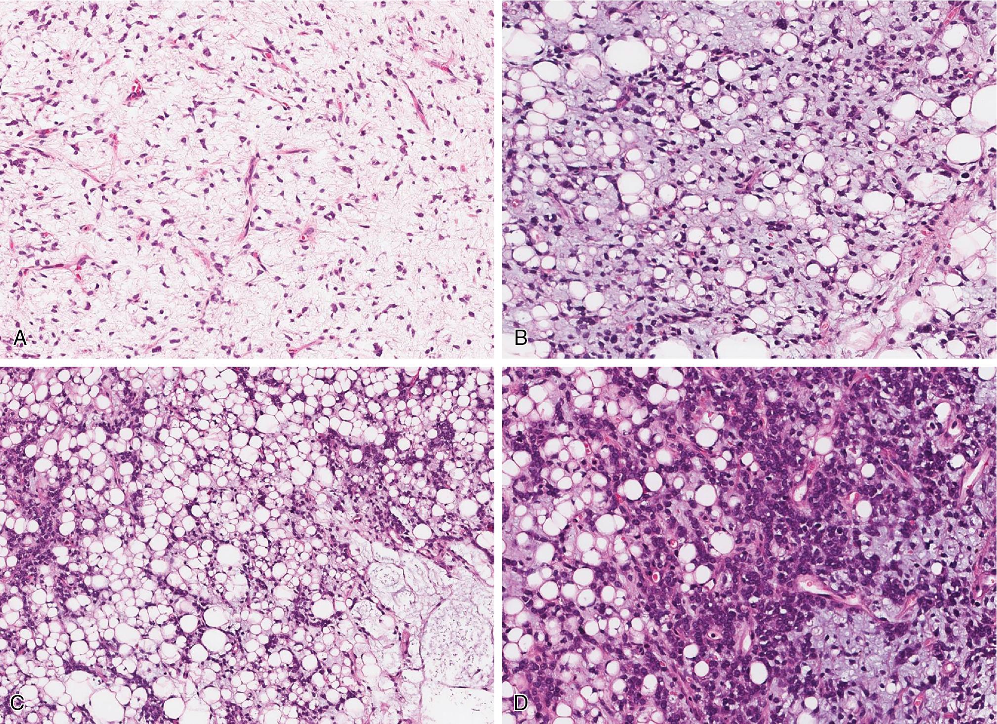 Fig. 8.11, Myxoid liposarcoma is composed of bland spindled to stellate cells embedded in a myxoid stroma with prominent delicate (“chicken wire”-like) vasculature (A) and variable amounts of monovacuolated (signet ring cell–like) lipoblasts (B) . High-grade myxoid liposarcomas, also known as round cell liposarcoma, display a population of larger cells with round nuclei and occasional prominent nucleoli, often clustering and covering the underlying myxoid stroma ( C, low power; D, high power).