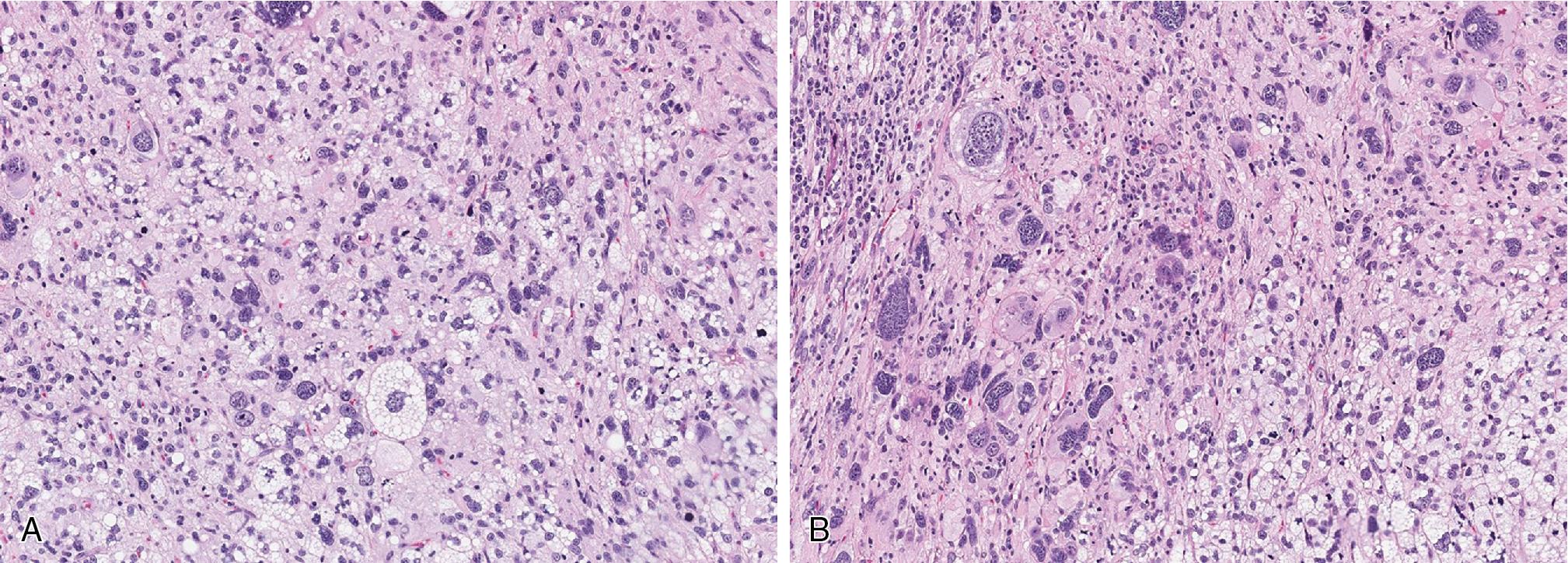 Fig. 8.12, A and B, Pleomorphic liposarcoma is a high-grade, pleomorphic spindled to epithelioid sarcoma defined by the presence of diagnostic multivacuolated lipoblasts.