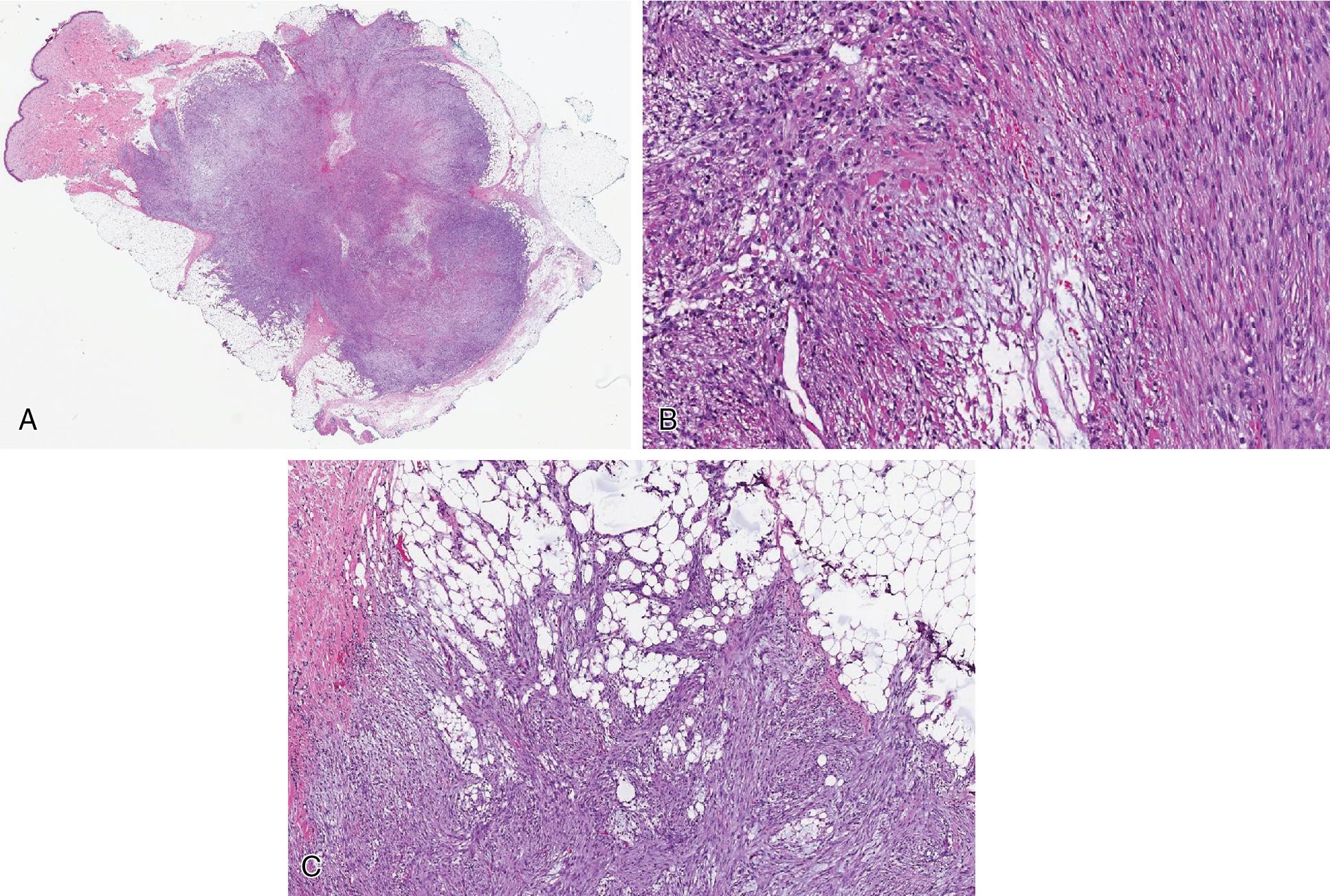 Fig. 8.13, Nodular fasciitis is a circumscribed, non-encapsulated neoplasm (A) , composed of plump, uniform and proliferating spindled cells, arranged loosely in short loose fascicles within a variably collagenous to myxoid stroma, often associated with microcysts and extravasated RBCs (B) . Despite appearing circumscribed grossly, it tends to show minor degrees of infiltration (C) .