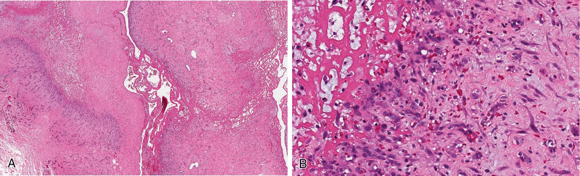 Fig. 8.14, Ischemic fasciitis has distinct zonal appearance (A) with areas of fibrinoid degeneration/necrosis and pseudocyst formation transitioning to a granulation tissue–like vascular proliferation with large ganglion-like reactive fibroblasts (B) .