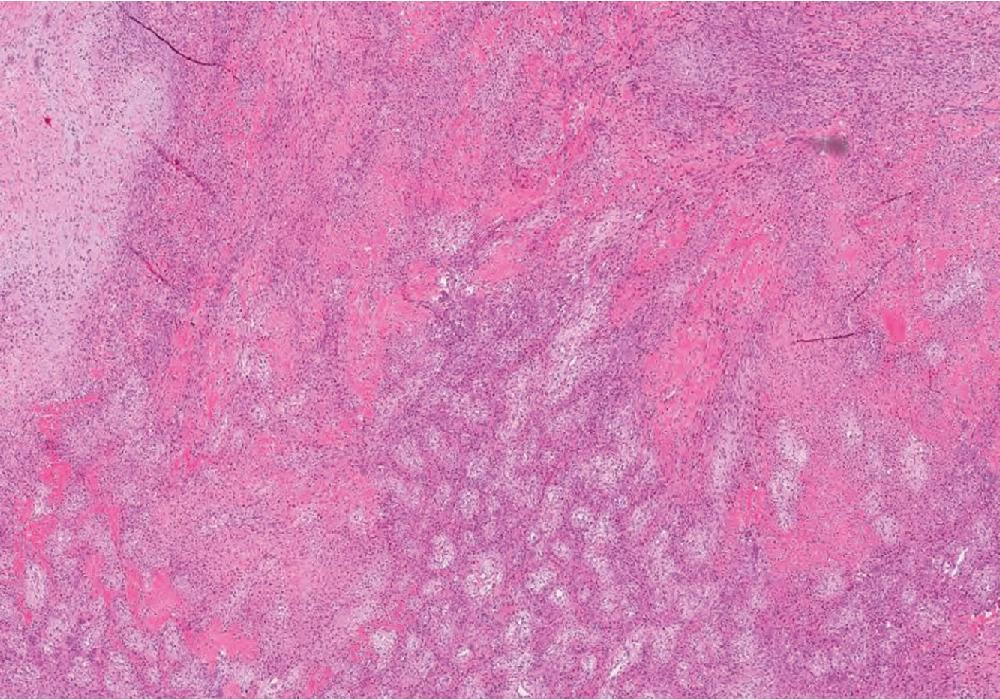 Fig. 8.17, Fibro-osseous pseudotumor of digits lacks the typical zonal morphology of usual myositis ossificans, with admixtures of bone trabecula and bland fibrous tissue, arising as a fusiform swelling of a digit.