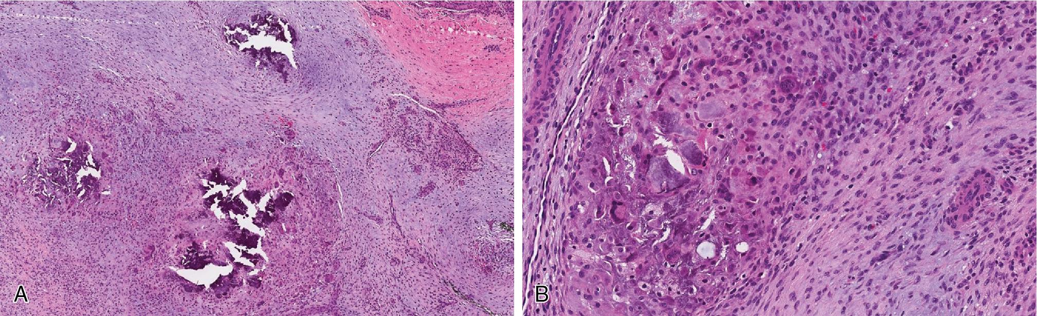 Fig. 8.18, Calcifying aponeurotic fibroma has infiltrative fibromatosis–like spindled cell areas admixed with less cellular areas of plump epithelioid fibroblasts with zones of calcification ( A, low power; B, high power).