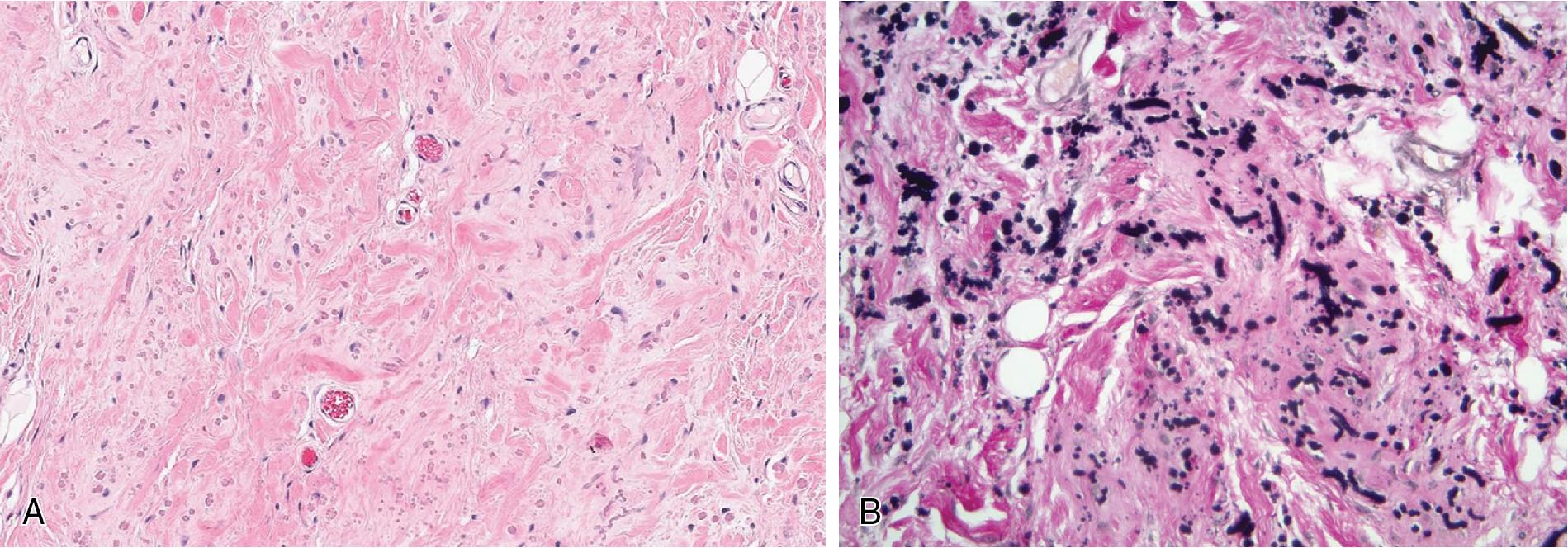 Fig. 8.20, Elastofibroma is an ill-defined mass, with variable amount of adipose and fibromyxoid tissue accompanied by increased abnormal and dystrophic elastic fibers (A) , highlighted by Elastin stain (B) .