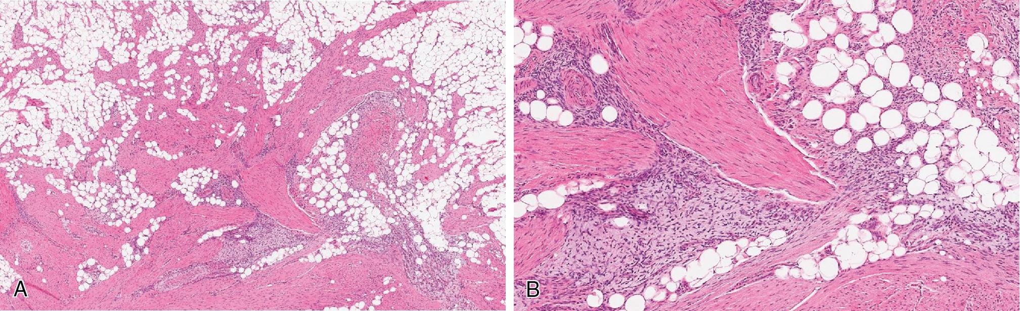 Fig. 8.21, Fibrous hamartoma of infancy has triphasic morphology with variable proportions of three distinct components: bland fibroblastic/myofibroblastic fascicles, primitive myxoid mesenchymal cells, and mature adipose tissue (A) . The primitive mesenchymal component consists of primitive, rounded to stellate cells within the myxoid stroma (B) .