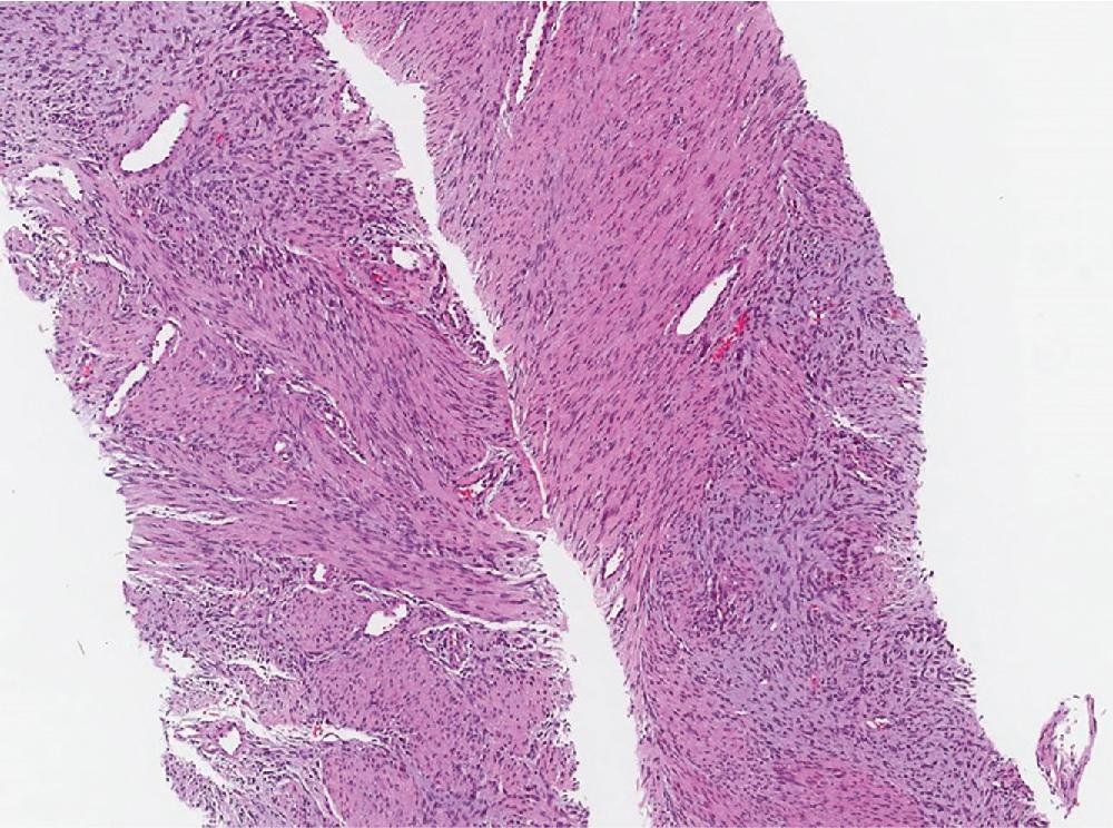 Fig. 8.22, Lipofibromatosis is characterized by cellular fascicles of fibromatosis-like tissue and fat infiltrating surrounding soft tissues. Small biopsy samples may not contain all components.