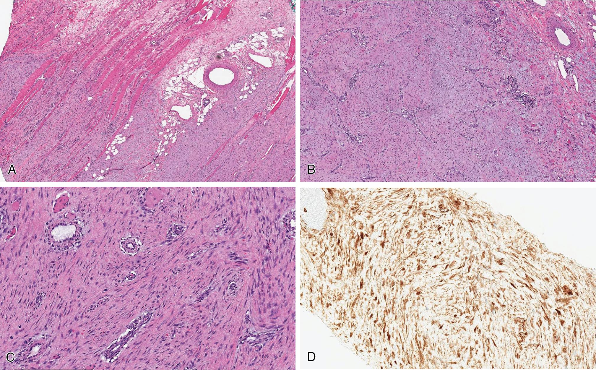 Fig. 8.23, Desmoid fibromatosis with long sweeping fascicles infiltrating the surrounding soft tissues and skeletal muscle (A) , often accompanied by lymphoid aggregates, peripherally (B) . The background stroma is usually uniformly collagenous with thin-walled blood vessels and characteristic perivascular edema (C) . Nuclear beta-catenin positivity may be helpful but is often inconsistently expressed (D) .