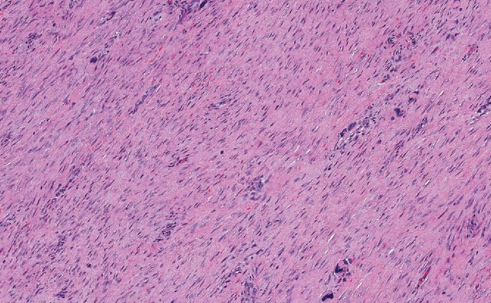 Fig. 8.24, Superficial (palmar/plantar) fibromatosis has overlapping morphologic features with desmoid fibromatosis, characterized by long sweeping fascicles of elongated and uniform spindled cells, enclosed within fibro-tendinous and fascial tissues.