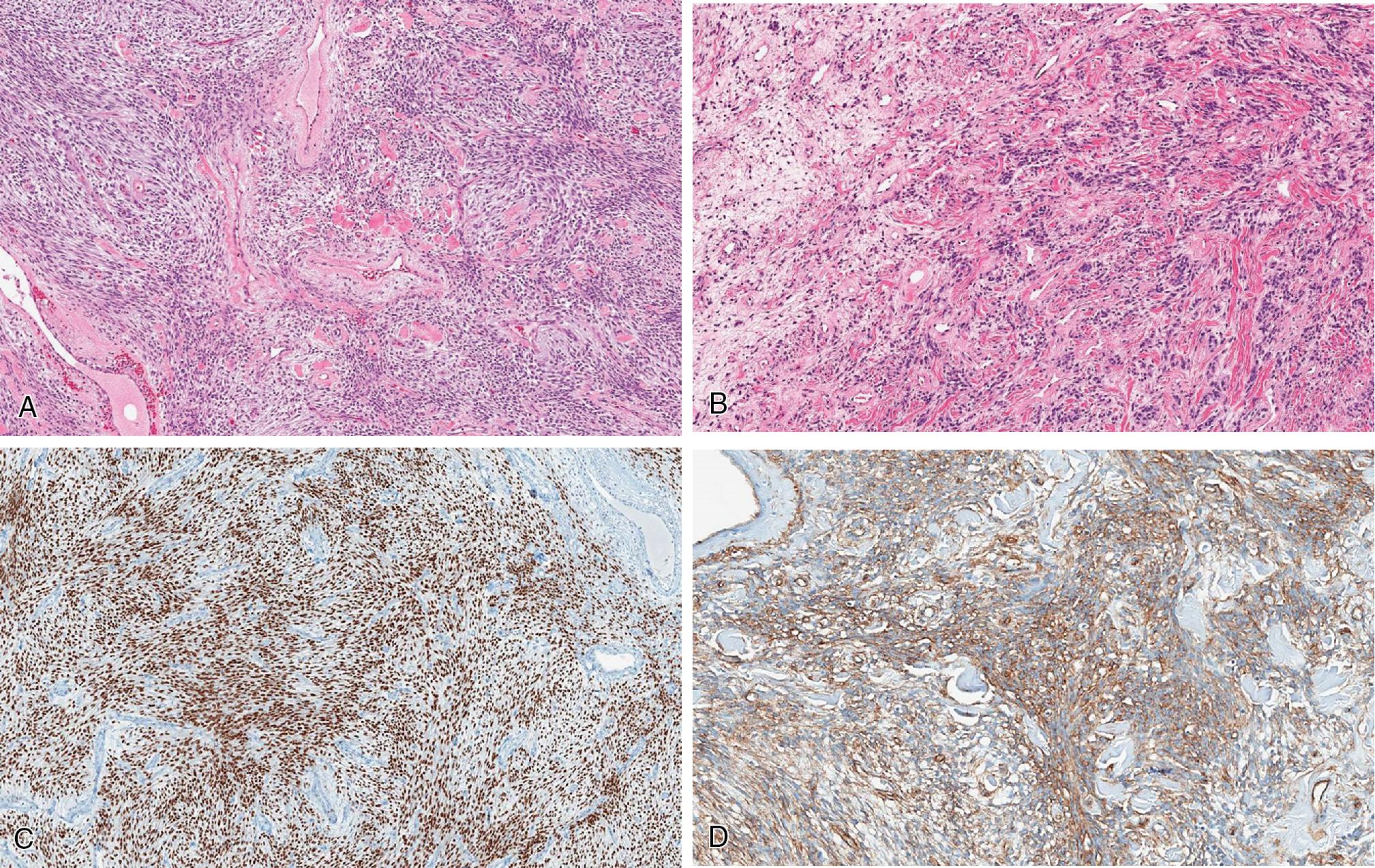 Fig. 8.26, Myofibroblastoma is a well-circumscribed, unencapsulated spindle cell neoplasm composed of short and stubby, uniform spindled cells with indistinct cell borders and eosinophilic cytoplasm arranged in short fascicles and sheets embedded in a variably myxoid stroma with scattered thick collagen fibers ( A, low power; B, high power). The cells are usually positive for desmin, ER (C) , and CD34 (D) .