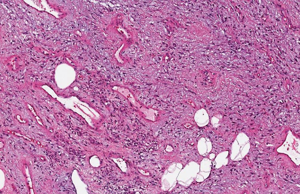 Fig. 8.27, Cellular angiofibroma is a circumscribed, hypercellular, and vascular neoplasm with an edematous to lightly myxoid stroma, accompanied by collagen bundles and prominent branching blood vessels.