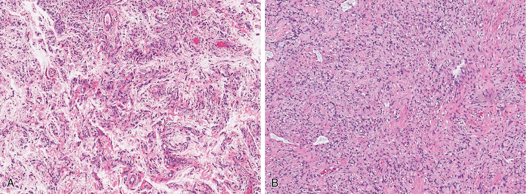 Fig. 8.29, A and B, Angiomyofibroblastoma is a well-circumscribed lesion, composed of spindled to epithelioid cells, often concentrated around blood vessels, within an edematous to lightly myxoid stroma with prominent vascularity.