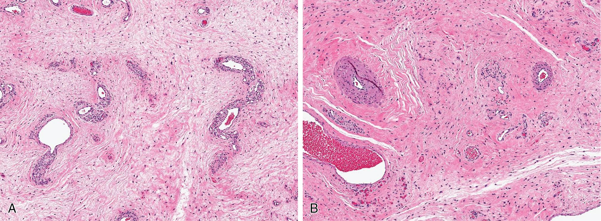 Fig. 8.30, A and B, Deep angiomyxoma is a relatively hypocellular but infiltrative spindled cell neoplasm, with abundant edematous to lightly myxoid stroma, admixed with medium to large muscular-walled blood vessels.