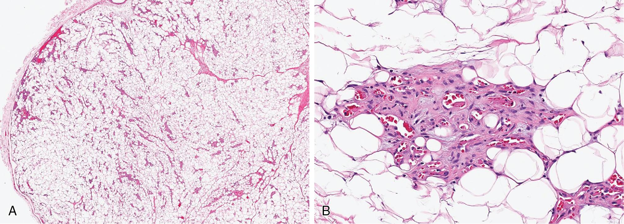 Fig. 8.3, Angiolipoma with sharp circumscription and variable numbers of characteristic small caliber blood vessels (A) with occasional microthrombi (B) .