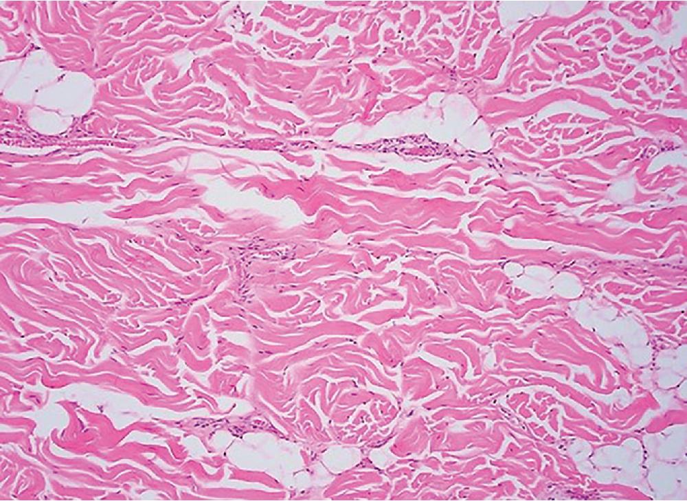 Fig. 8.31, Nuchal-type fibroma forms a poorly circumscribed, hypocellular lesion, composed of monomorphic spindled cells, within a background composed of thick collagenous bundles, often entrapping fat and small peripheral nerves.