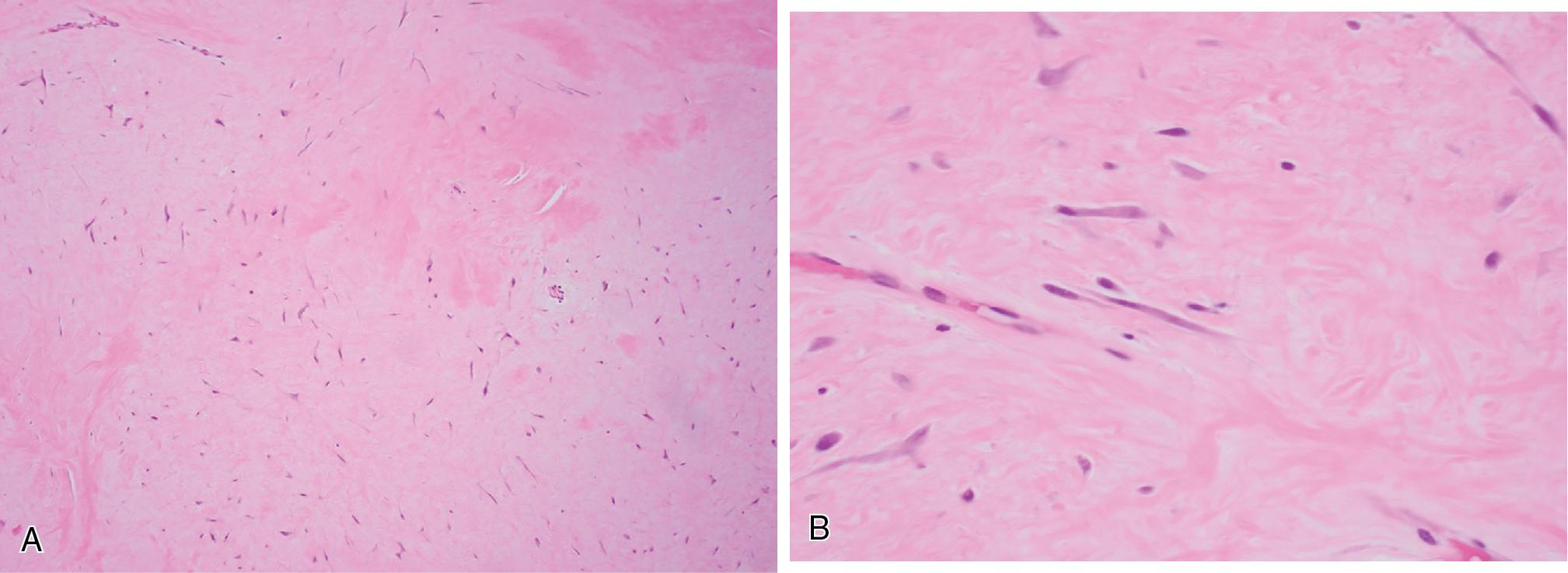 Fig. 8.32, Desmoplastic fibroblastomas are relatively circumscribed, hypocellular neoplasms composed of bland stellate to spindled fibroblasts with an abundantly and uniformly collagenous to lightly myxoid stroma ( A, low power; B, high power).