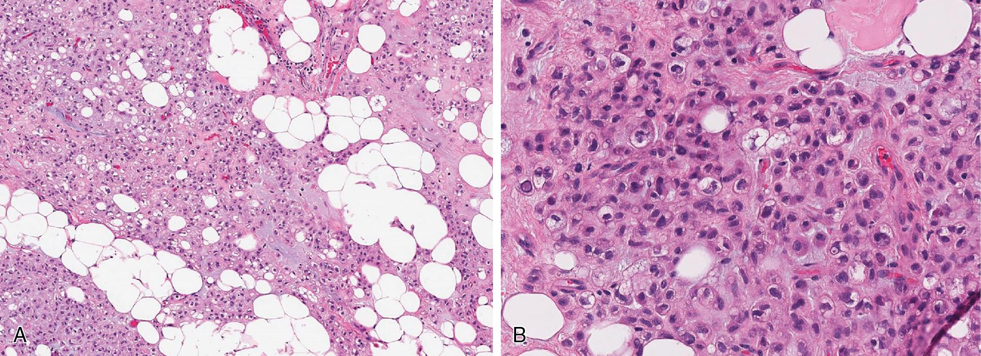 Fig. 8.4, (A, B) Chondroid lipoma showing mature adipose tissue admixed mononuclear chondroblastoma-like cells and lipoblasts within a chondroid to myxohyaline stroma.