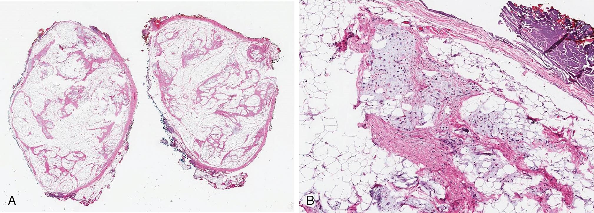Fig. 8.5, Lipoblastoma is a well-circumscribed, lobulated adipocytic neoplasm with thick fibrous septa (A) composed of variably mature adipocytes intermixed with less mature cells and variably myxoid stroma (B) . The latter appearance can mimic myxoid liposarcoma.
