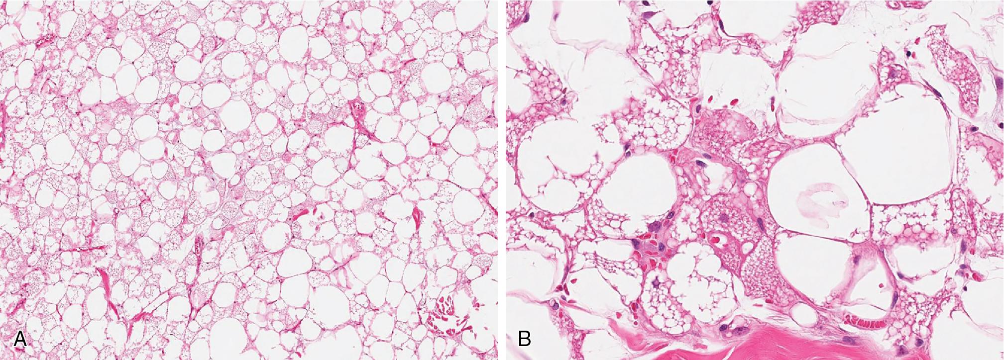 Fig. 8.6, A variable mixture of mature adipocytes and multivacuolated brown fat is characteristic for a hibernoma (A) . Many of multivacuolated cells appear eosinophilic, with centrally placed, round nuclei with fine chromatin material and prominent nucleoli (B) .