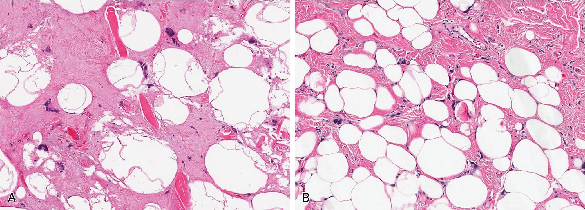 Fig. 8.8, A and B, Pleomorphic lipomas represent a spectrum of spindle cell lipomas being additionally defined by the presence of multinucleated giant “floret-like” cells within a variably fibromyxoid stroma.