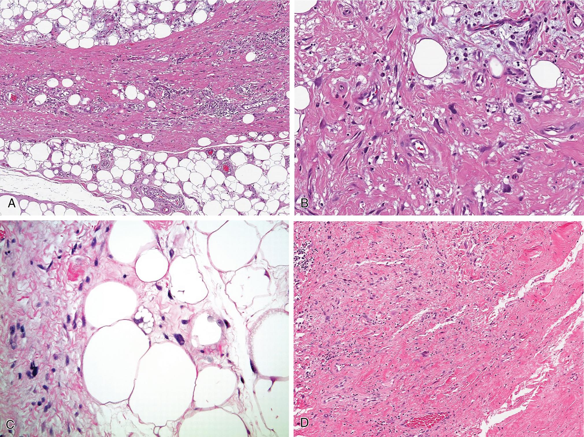 Fig. 8.9, At low power, atypical lipomatous tumor/well-differentiated liposarcoma (ALT/WDL) is characterized by variably amounts of fibrous and adipose tissue, often displaying heterogeneity within individual adipocytes (A) . Atypical, enlarged, and often multinucleated cells are within fibrous tissue and adjacent to adipocytes (B) . Less commonly, multivacuolated lipoblasts are seen (C) . The sclerosing variant of ALT/WDL is composed predominantly of dense, hypocellular fibrous tissue but retains the characteristic atypical and enlarged multinucleated cells (D) .