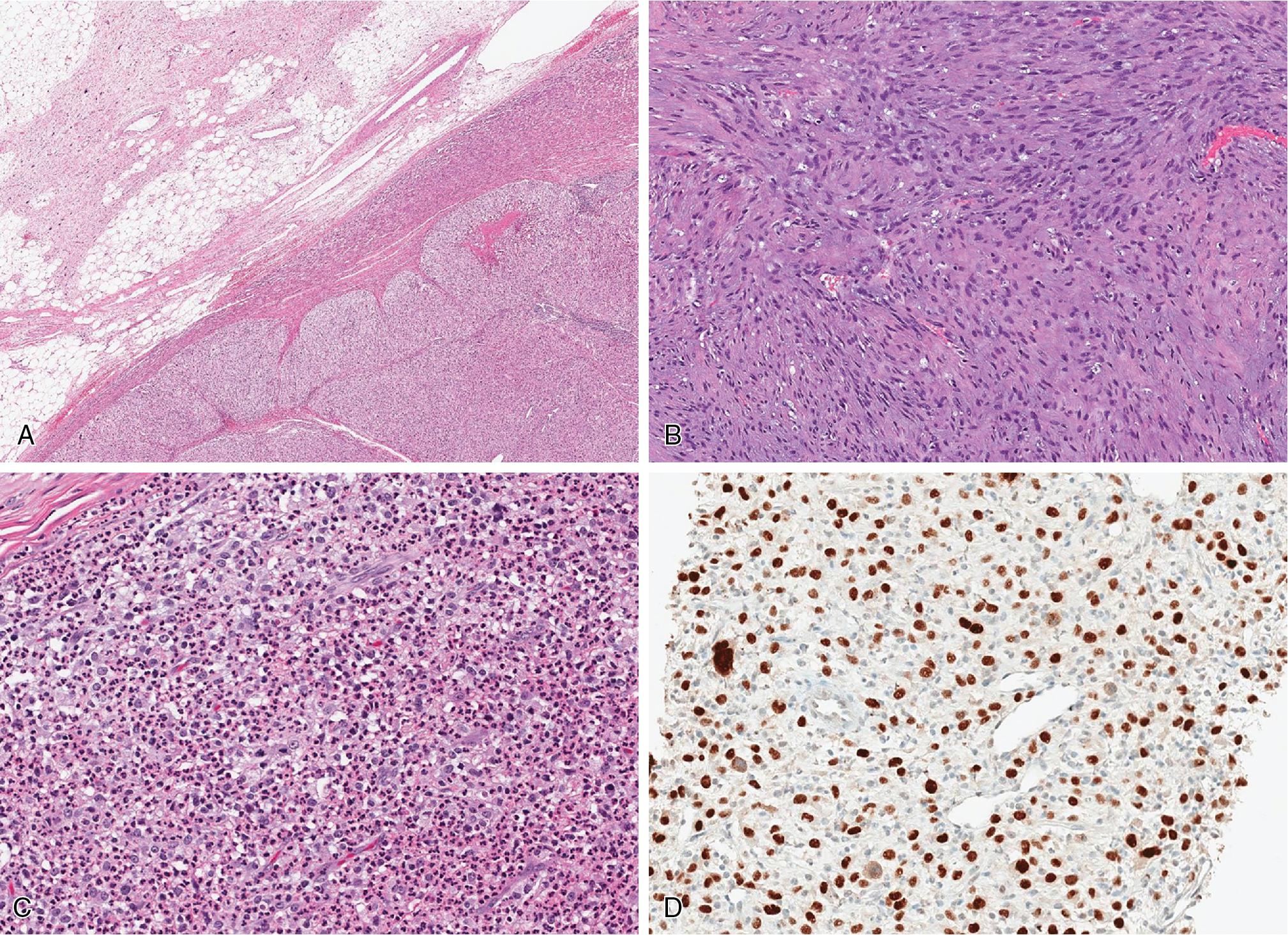 Fig. 8.10, Dedifferentiated liposarcoma is defined by the presence of high-grade sarcoma juxtaposed to atypical lipomatous tumor/well-differentiated liposarcoma (A) . The histologic features of the high-grade component can be diverse, but most resemble an undifferentiated pleomorphic sarcoma or fibrosarcoma (B) . Abundant background inflammation may confound the diagnosis (C) . An MDM2 immunohistochemical stain can be helpful in highlighting the neoplastic cells in dedifferentiated liposarcoma (D) .