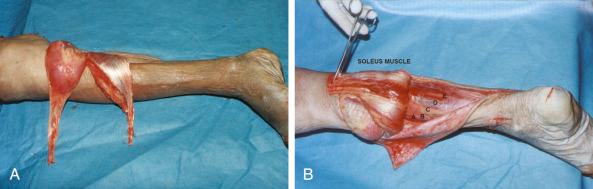 Figure 51.2, (A) Cadaver dissection showing the soleus elevated proximally-based. (B) The gastrocnemius muscle is pedicled to cover the proximal leg and the soleus muscle is pedicled to cover the middle third of the leg. Labels: a . Flexor digitorum longus muscle; b . posterior tibial artery and vein; c . tibial nerve; d . tibialis posterior muscle; e . flexor hallucis longus muscle.