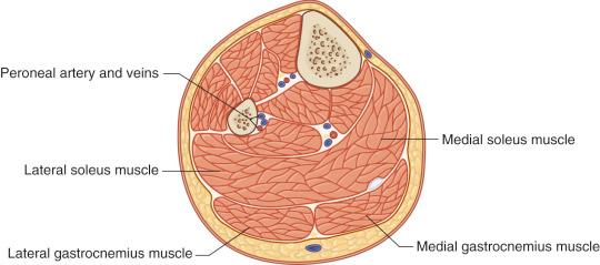 Figure 51.3, Schematic cross-section relative to soleus–fibula transfer.