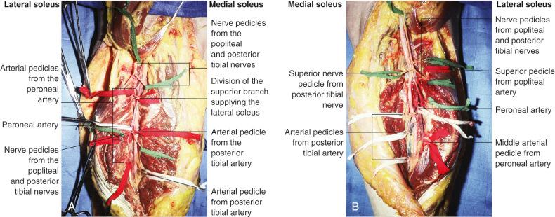 Figure 51.5, Dissection of the calf through a vertical incision with individualization of vessels and nerve supply to the lateral and medial soleus. (A) Left leg. (B) Right leg.