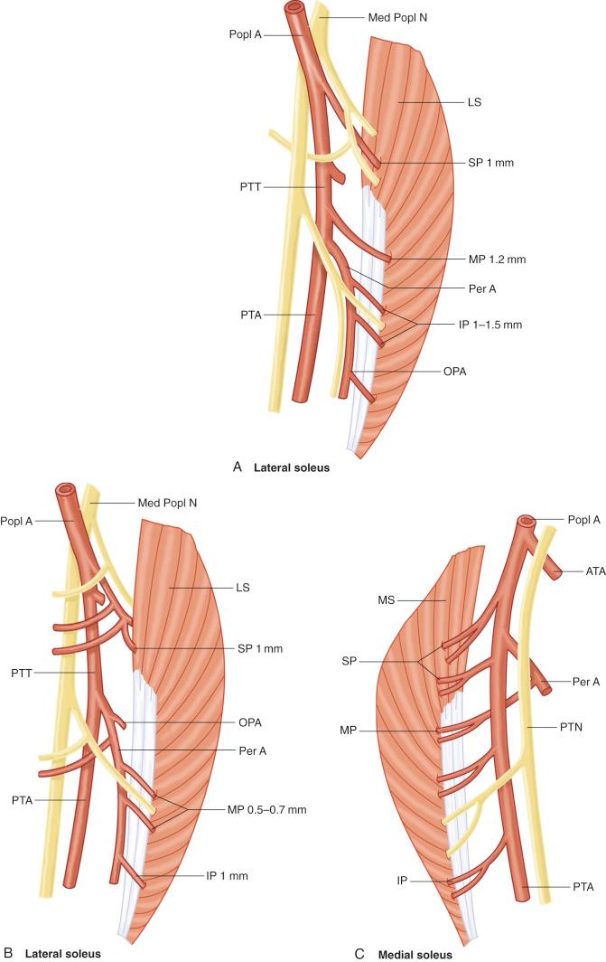 Figure 51.6, (A) The lateral soleus. A less common vasculo-nervous pattern. The superior pedicle (SP) comes from the popliteal artery and the middle pedicle (MP) from the peroneotibial trunk (PTT). The peroneal artery (Per A) gives rise to the inferior pedicle (IP) and finally the osteoperiosteal artery (OPA). The posterior tibial artery (PTA) does not supply the lateral soleus (LS). In black, are seen the nerve pedicles to the LS. (B) The most common vascular and nerve supply to the lateral soleus. SP, superior pedicle comes from the popliteal artery (Popl A). The middle pedicle (MP) is double and comes from the Per A. The inferior pedicle (IP) originates from the Per A. The OPA emerges from the Per A a few millimeters from its origin from the PTT. In this case, the PTA does not supply the lateral soleus. In black, are seen the nerve pedicles to the LS. Med Popl N, medial popliteal nerve. (C) Medial head of the soleus (MS). ATA, anterior tibial artery; PTN, posterior tibial nerve.