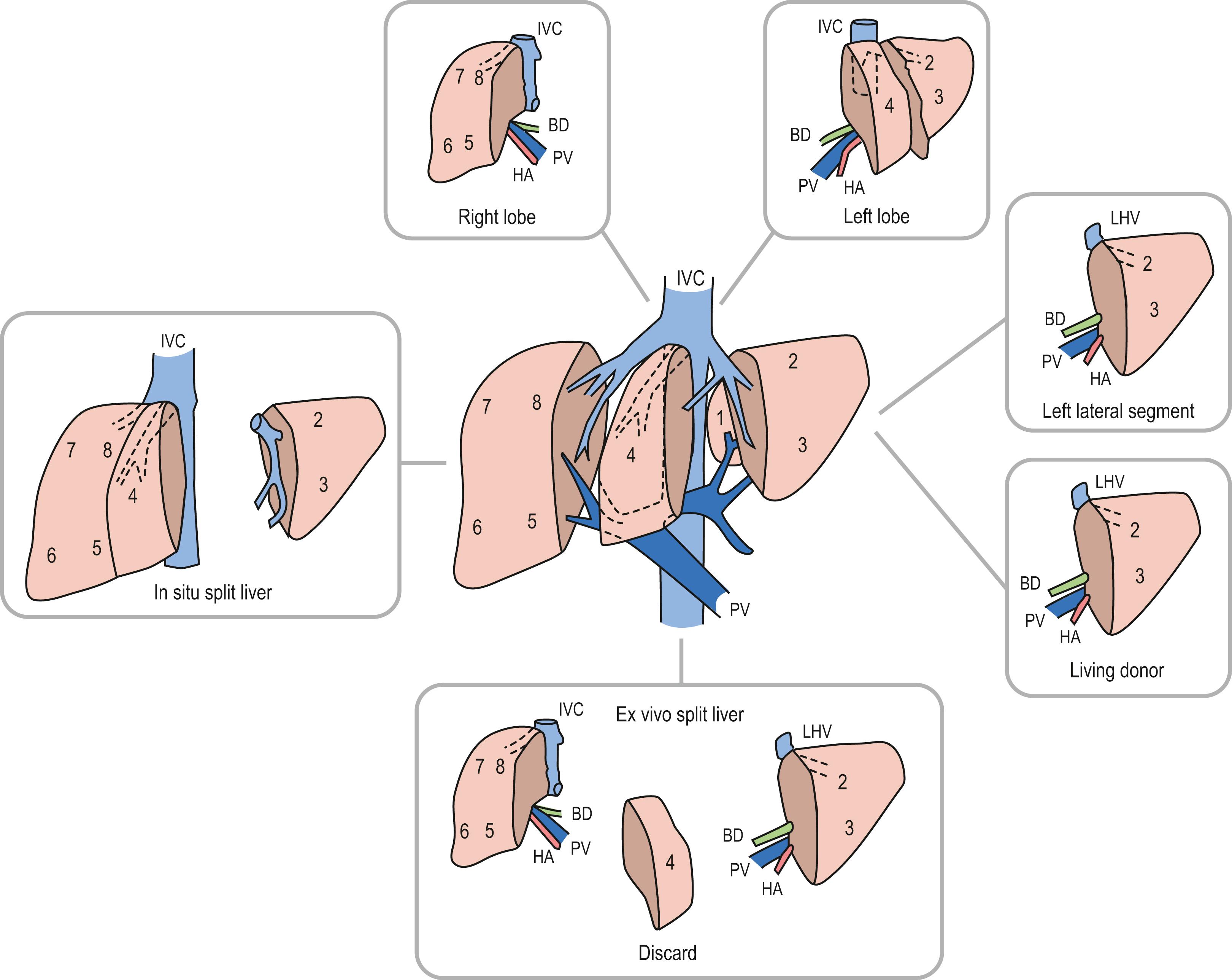 Fig. 45.4, Anatomic donor options available through surgical reduction. The numbers correlate to the segmental hepatic anatomy as defined by Couinaud. BD, bile duct; HA, hepatic artery; IVC, inferior vena cava; LHV, left hepatic vein; PV, portal vein.